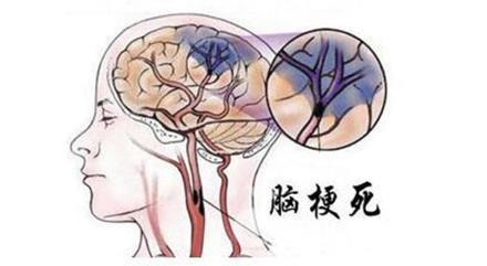 玩手机脑梗新闻玩手机猝死的真实案例-第2张图片-太平洋在线下载